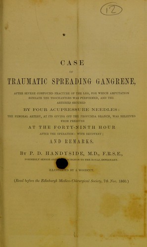 Case of traumatic spreading gangrene, after severe compound fracture of the leg, for which amputation beneath the trochanters was performed, and the arteries secured by four acupressure needles