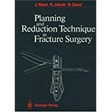 Planning and reduction technique in fracture surgery